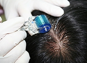 Применение мезороллера для лечения выпадения волос