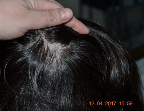 Фотография макушки женщины после лечения