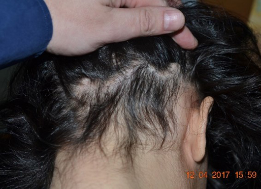 Фотография затылка женщины после лечения