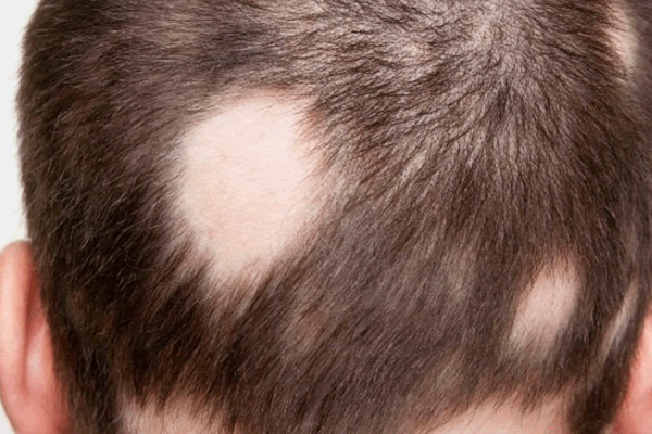 Гнездная алопеция - это одно из самых неприятных и тяжелых заболеваний кожи головы