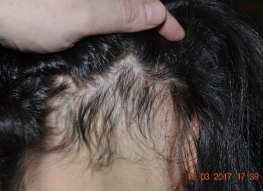 Фотография затылка женщины до лечения