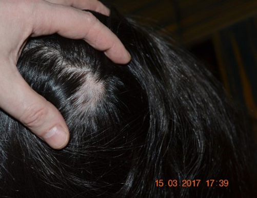 Фотография макушки женщины до лечения